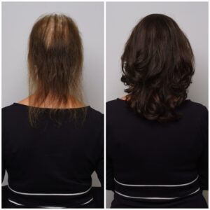 RG Hairstudio Markeline (Before and After 6)