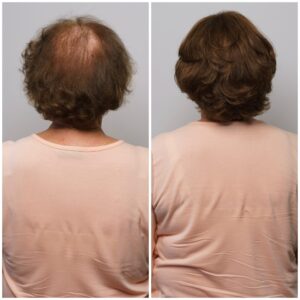 RG Hairstudio Markeline (Before and After 7)
